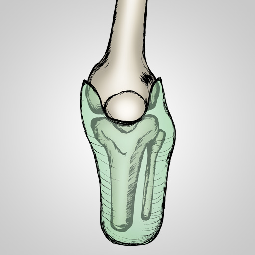 Fracture du tibia - Clinique Drouot