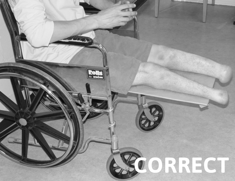 Correct Wheelchair Positioning for Transtibial Patient