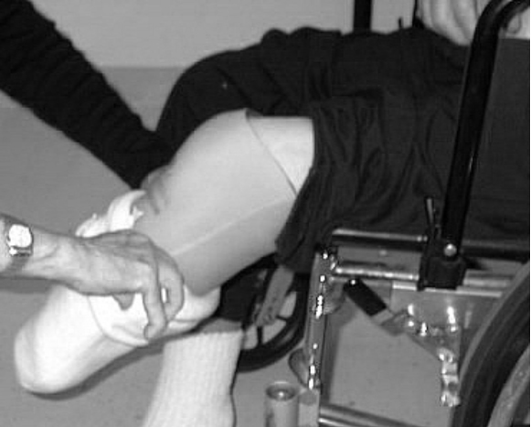 Transtibial Prosthetics