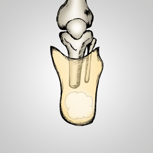 Vacuum Assisted Suspension - Transtibial - Socket Finder